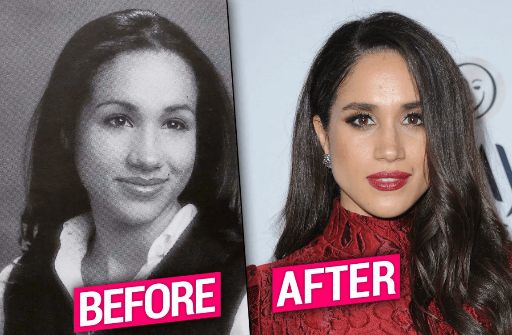 Meghan Markle Plastic Surgery The Royal Transformation