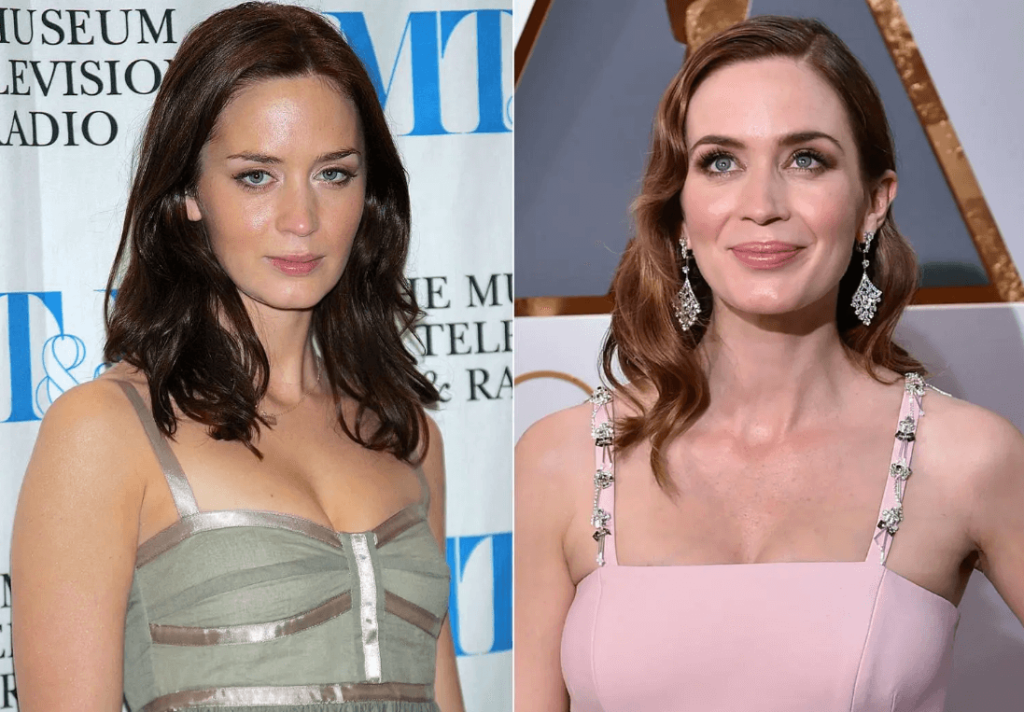 Emily Blunt Plastic Surgery Before After Plasticsurgeryinsights