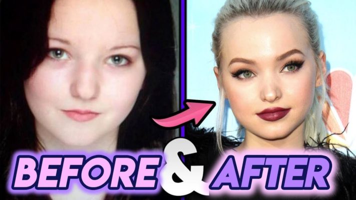 Dove Cameron Plastic Surgery: Before & After Photos ...