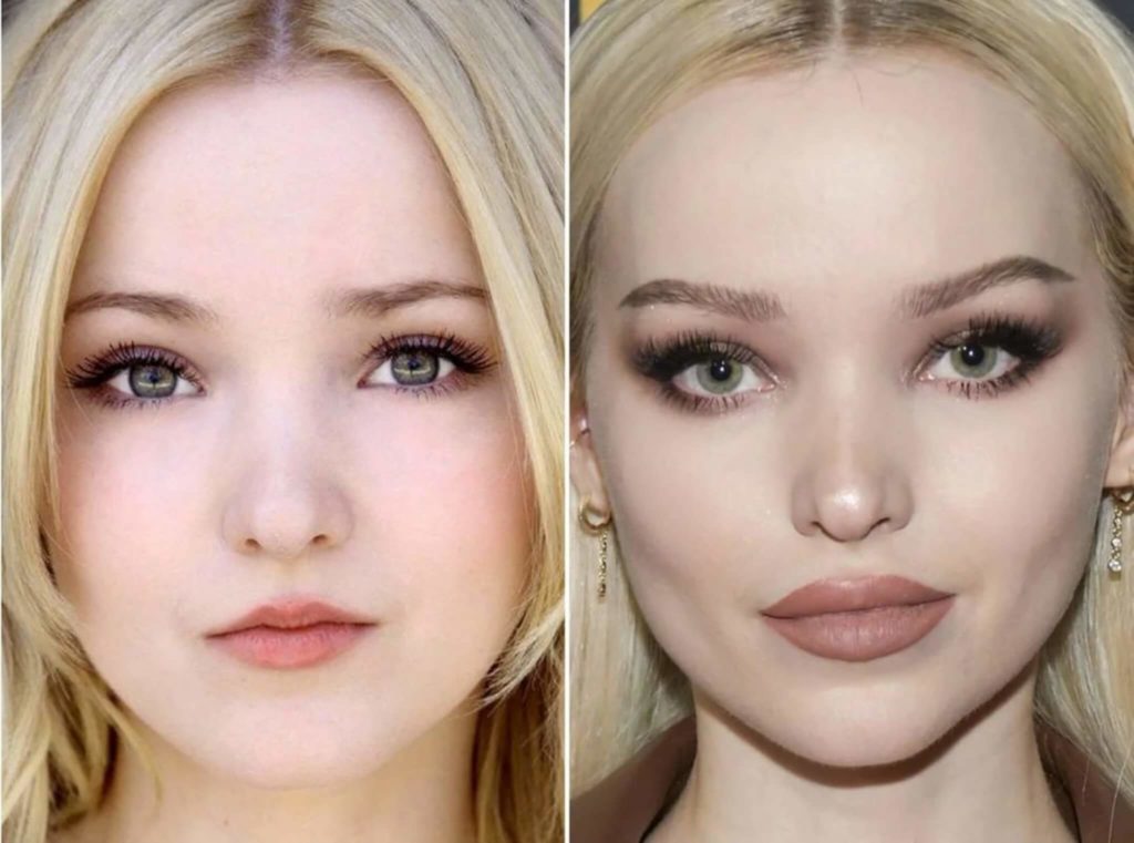 Dove Cameron Plastic Surgery: Before & After Photos ...