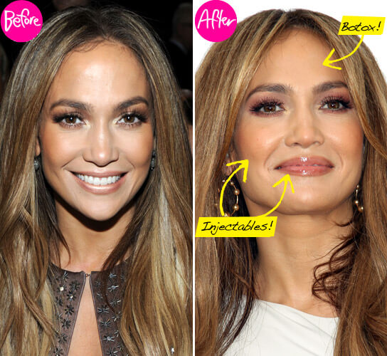 Jennifer Lopez Facelift