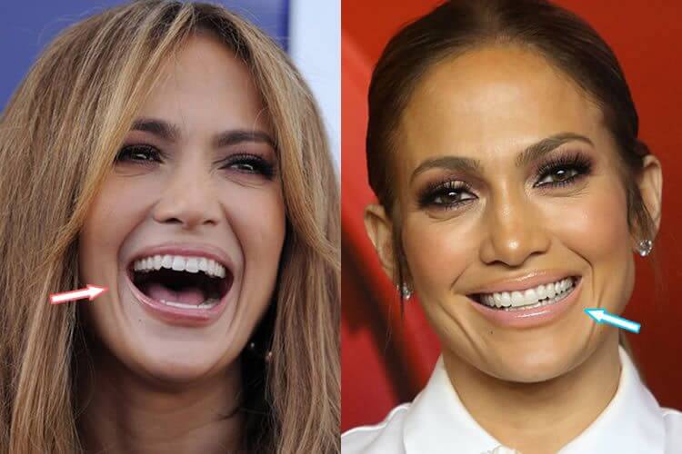 Jennifer Lopez Teeth