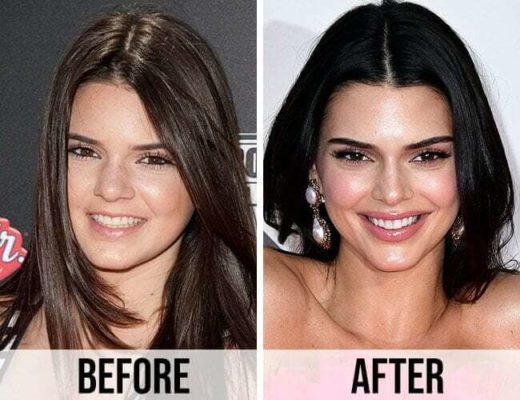 Kendall Jenner Plastic Surgery: Rumors, Before & After ...