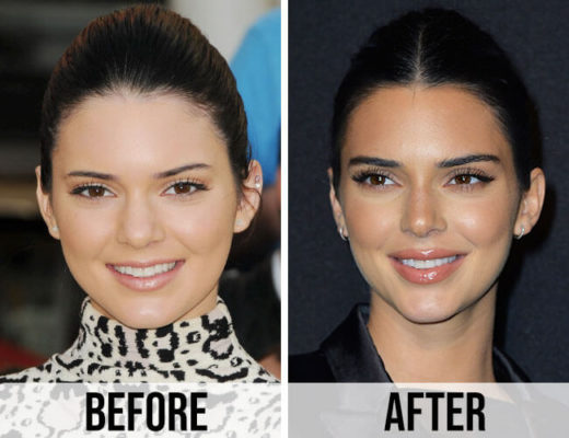 Kendall Jenner Plastic Surgery: Rumors, Before & After ...