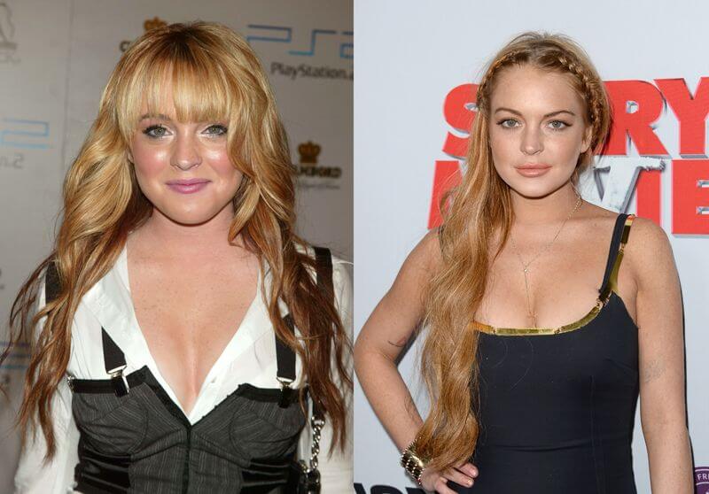 Lindsay Lohan Botox