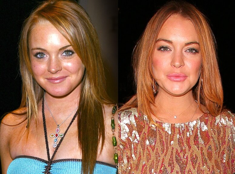 Lindsay Lohan Eyelid