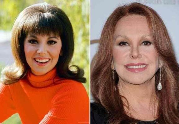 Marlo Thomas Plastic Surgery: Before & After Transformations ...