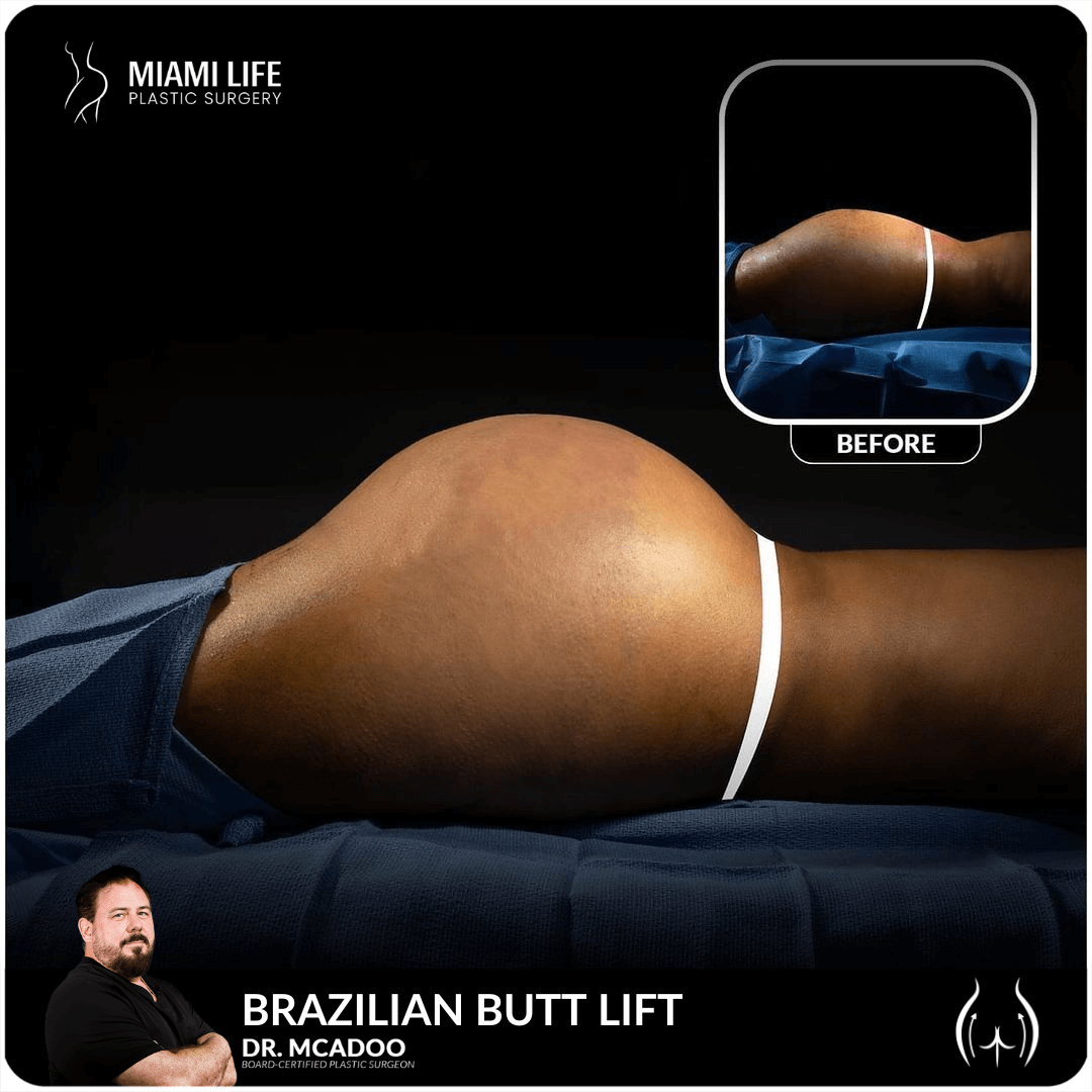 Miami Life Plastic Surgery Brazilian Butt Lift