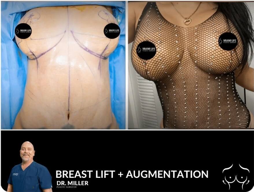 Miami Life Plastic Surgery Breast