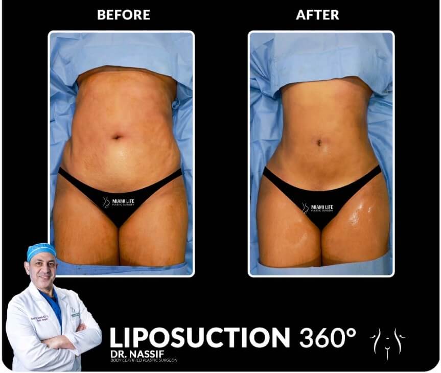 Miami Life Plastic Surgery Liposuction