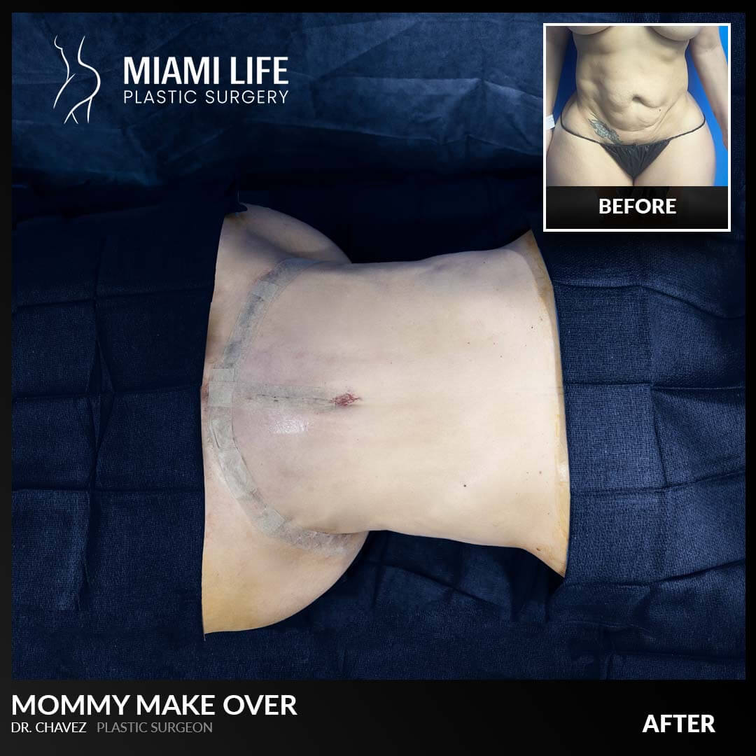 Miami Life Plastic Surgery Mommy Make Over