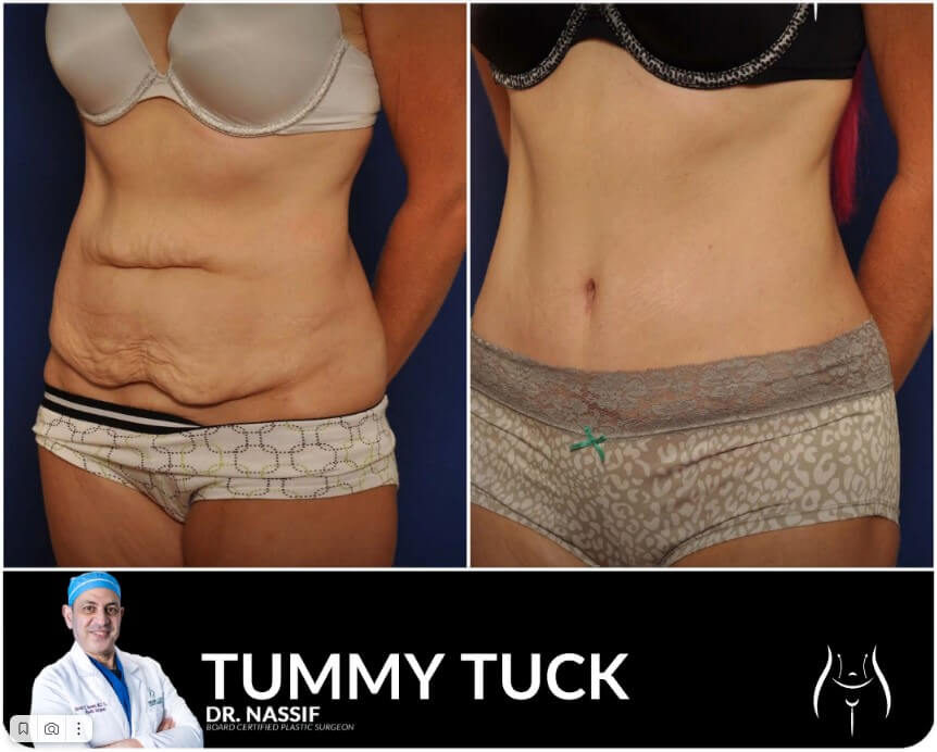 Miami Life Plastic Surgery Tummy Tuck
