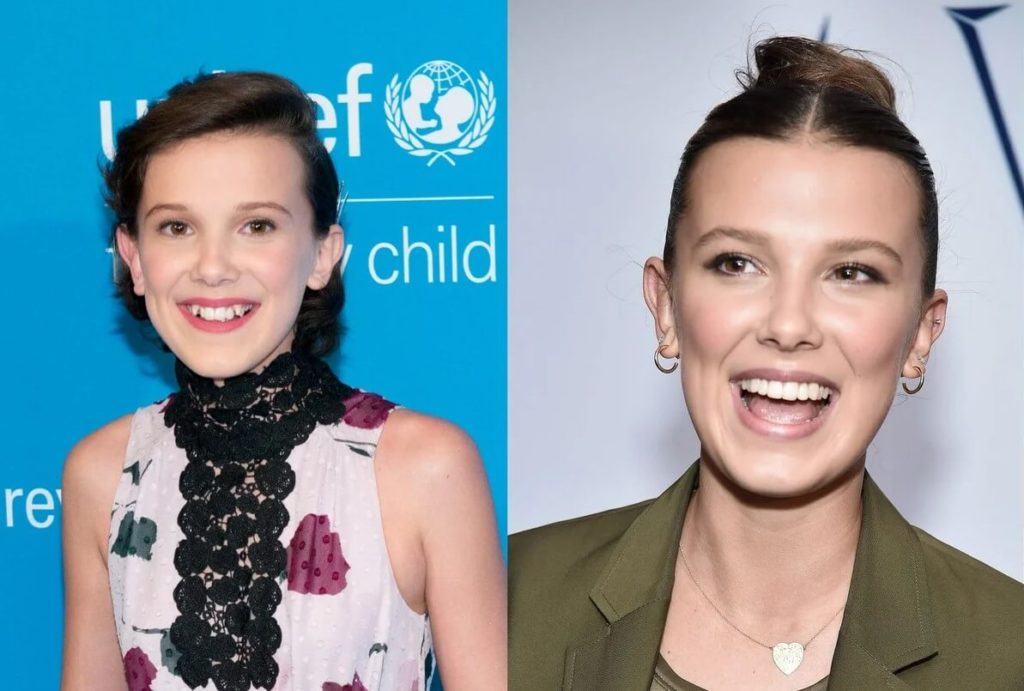 Millie Bobby Brown Plastic Surgery: Rumors, Expert Opinion & Analysis ...