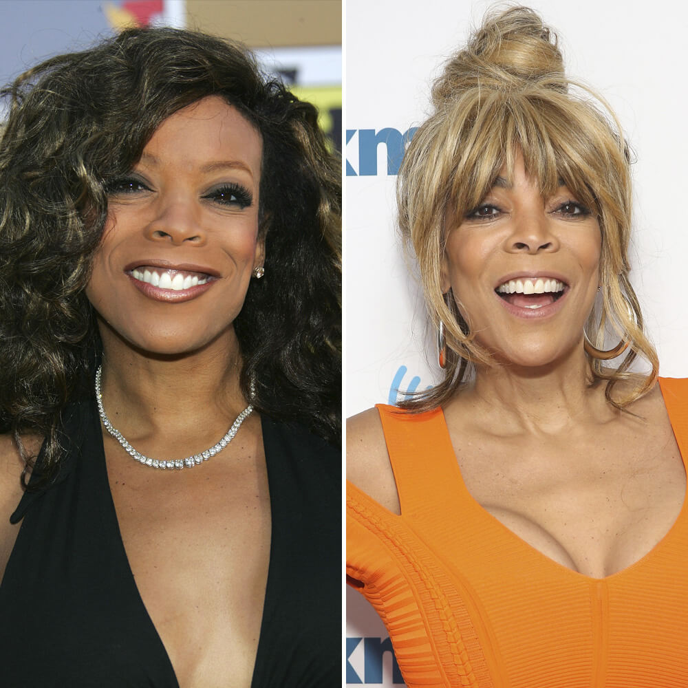 Wendy Williams Facelift