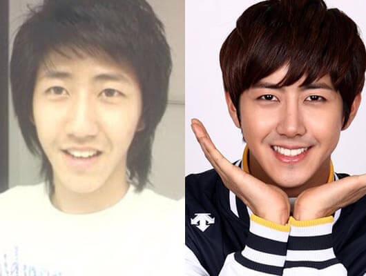 Kwanghee Before and After
