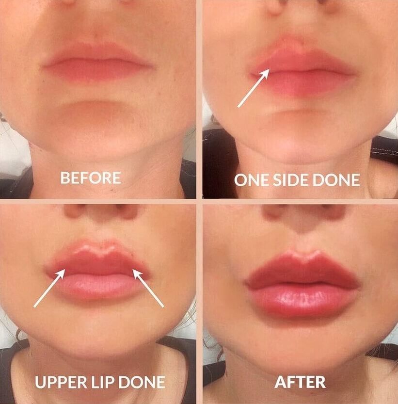 Lip Filler Effects