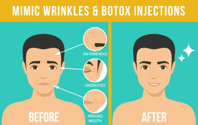 Botox Transformations: Before and After Photos | PlasticSurgeryInsights.com