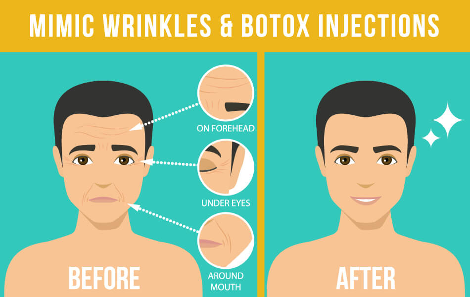 Mimic Wrinkles and Botox Injections