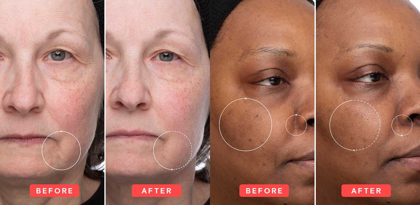 Retinol Before and After