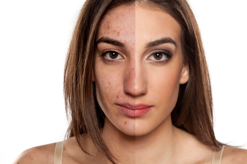 Tretinoin Acne Before and After