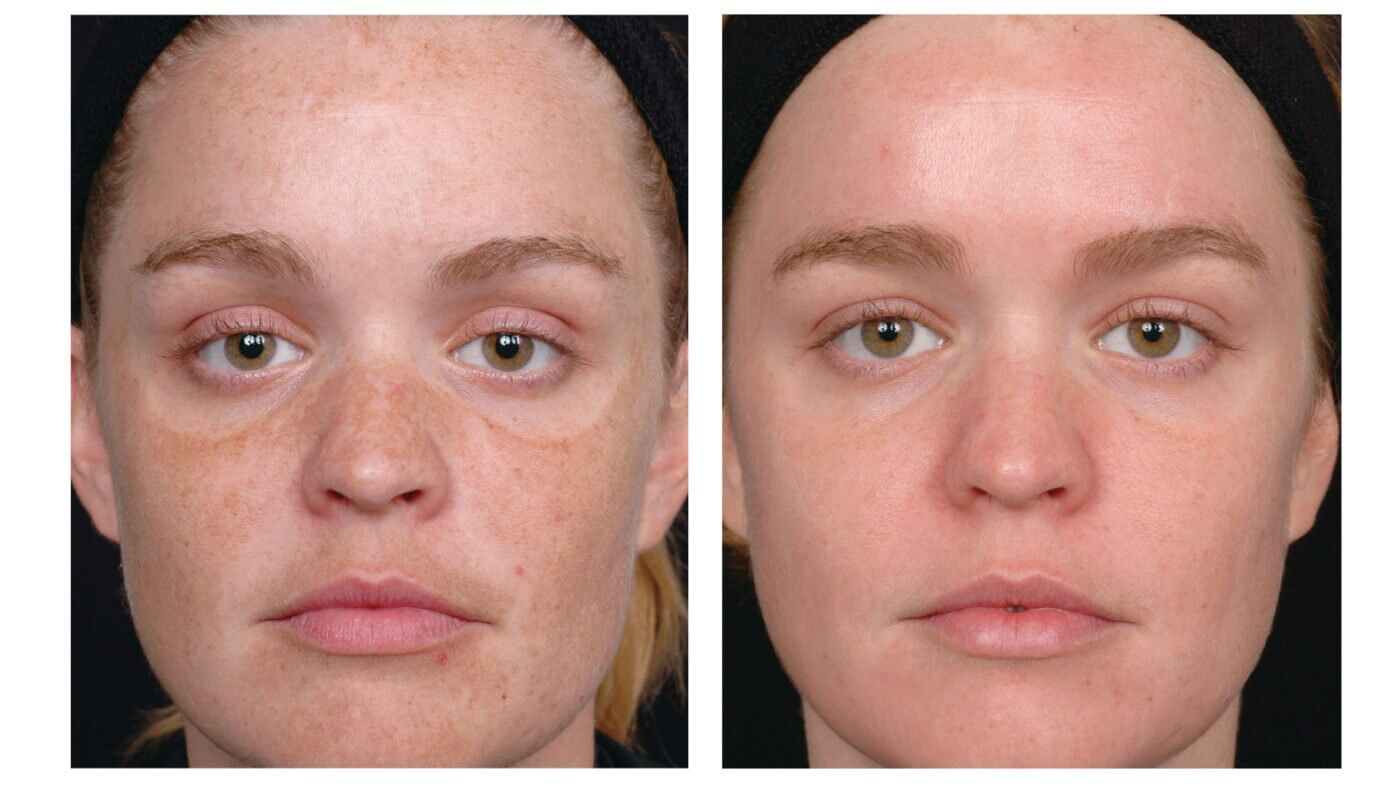 Tretinoin Hyperpigmentation Before and After