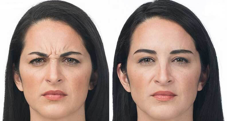 Tretinoin Wrinkles Before and After