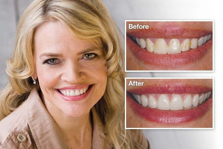 Veneers Before and After Result