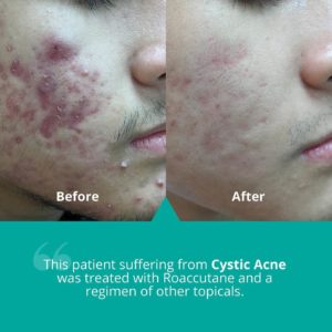 Accutane Before and After: Remarkable Skin Transformations ...