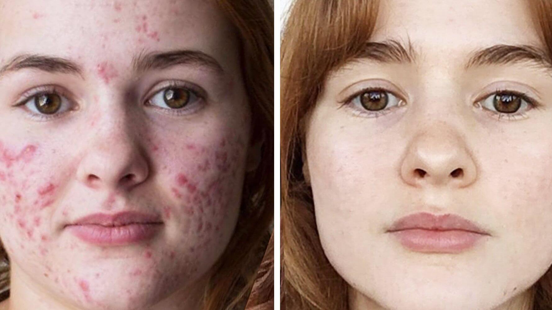 Accutane Before and After Result