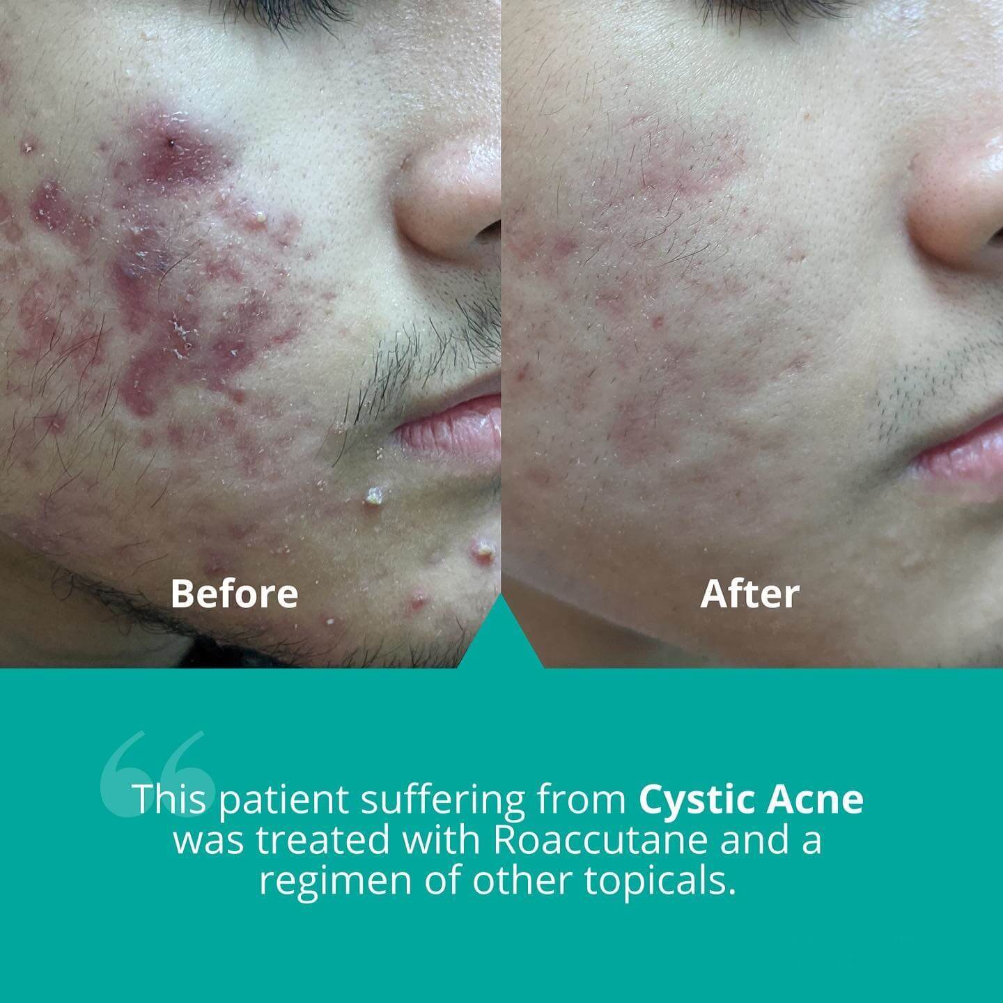 Accutane Before and After