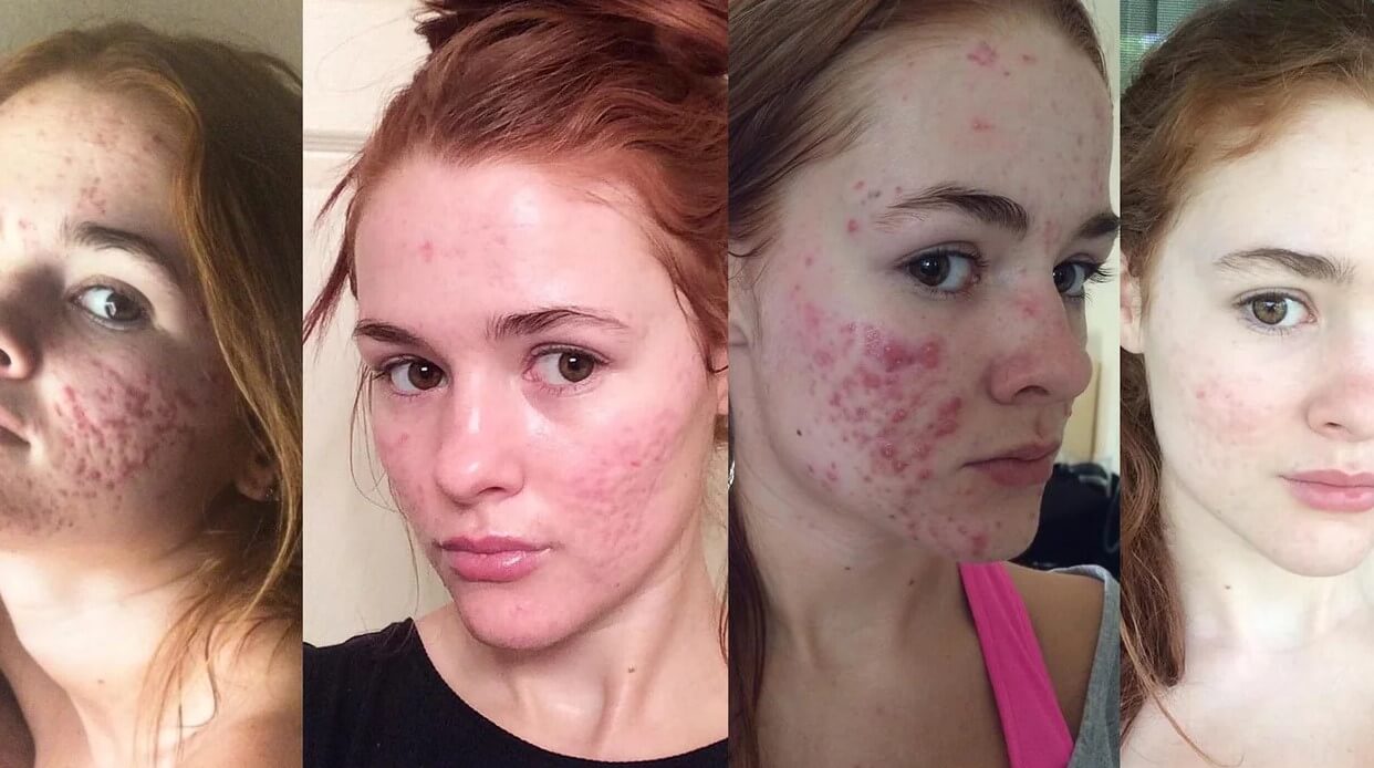 Accutane Then and Now
