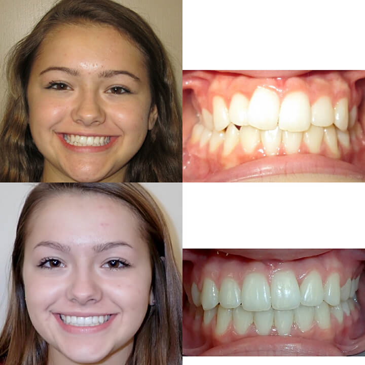 Braces Before and After Case