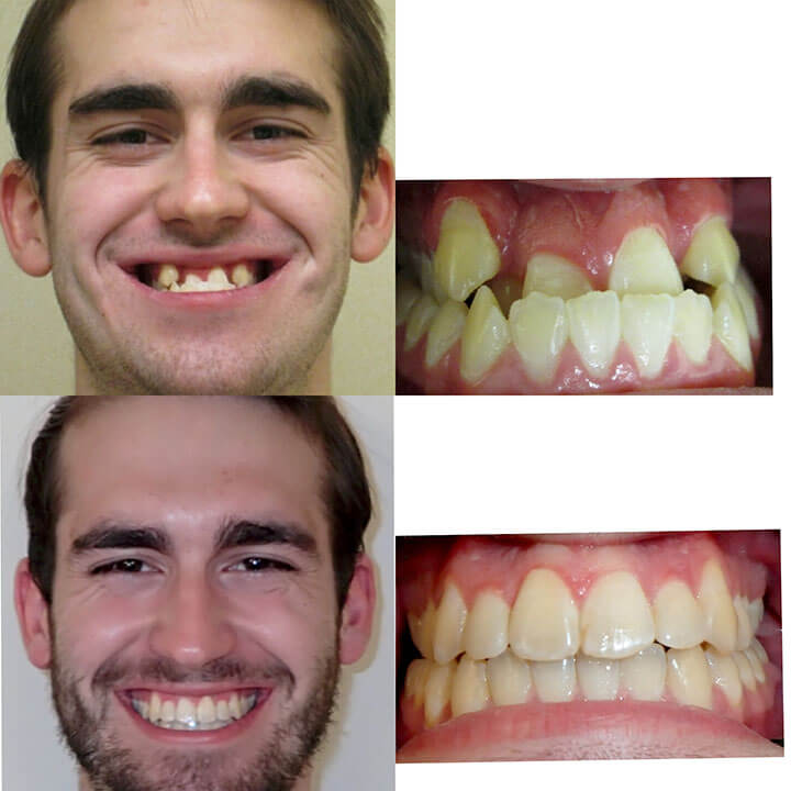 Braces Before and After Result