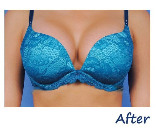 Breast Lift After Result