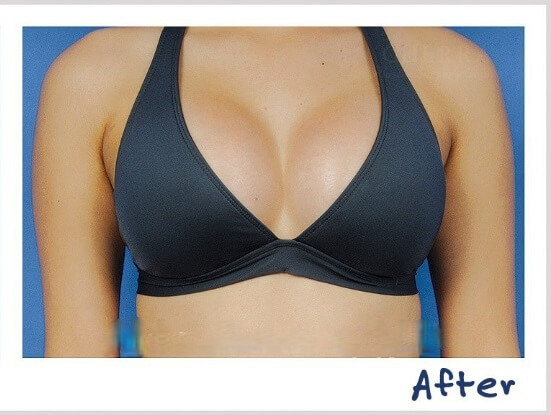 Breast Lift After Result