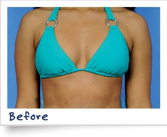 Breast Lift Before Result