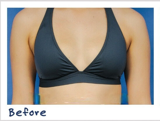 Breast Lift Before Result