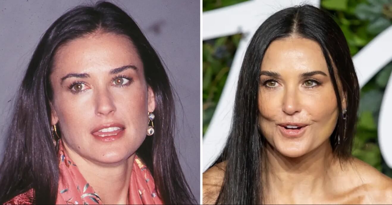 Demi Moore Botox Before and After
