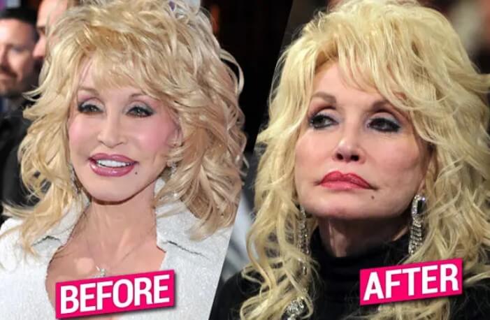 Dolly Parton Cosmetic Surgery