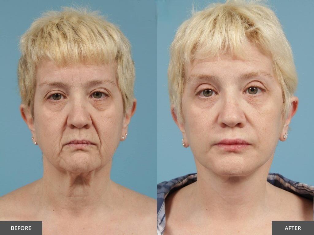 Facelift Before and After Result