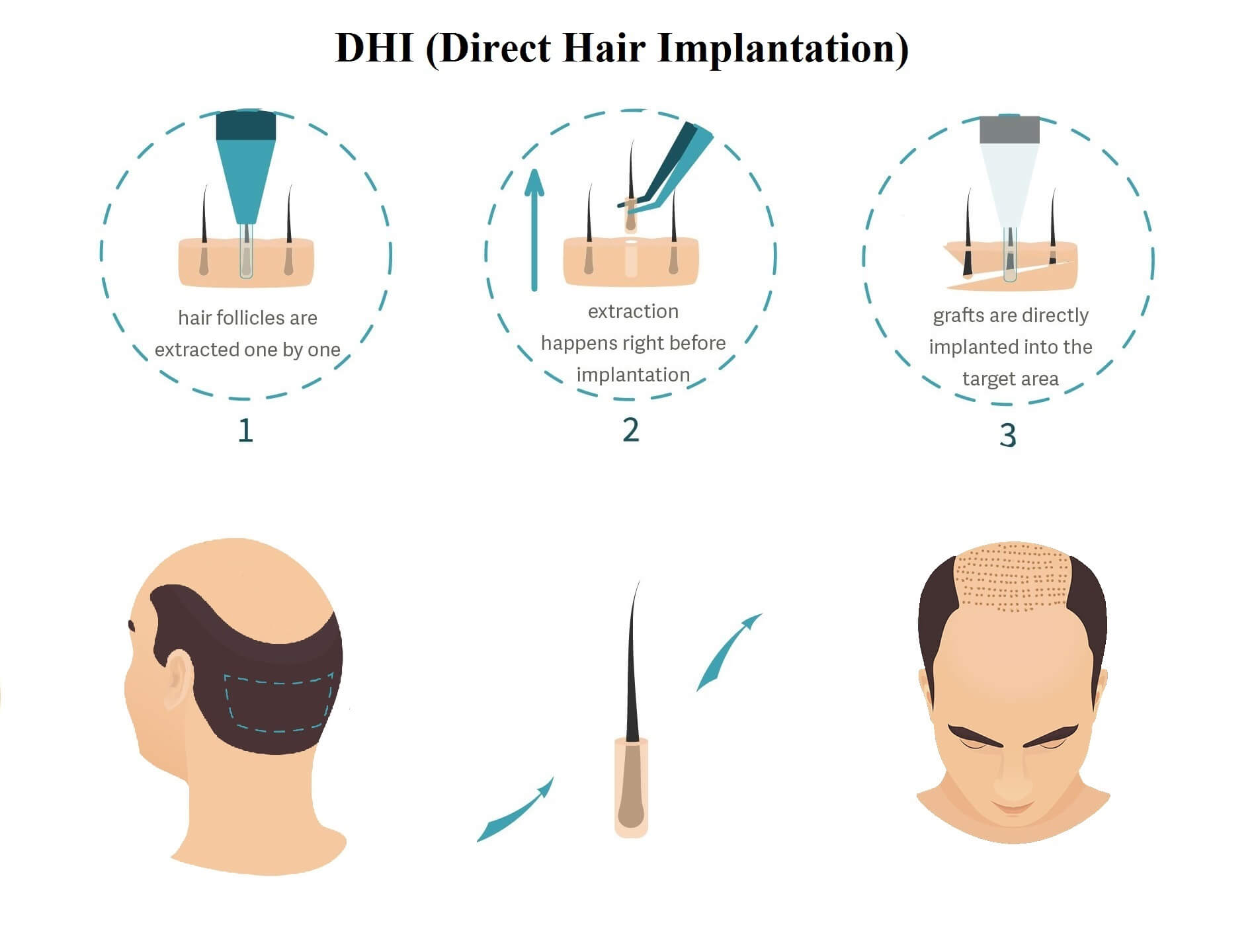Hair Implantation
