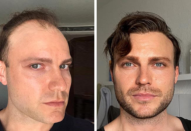 Hair Transplant Before and After Result