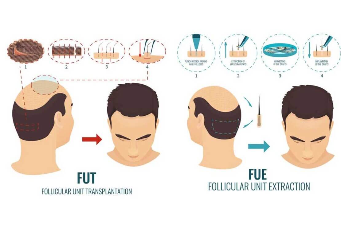 Hair Transplant Techniques