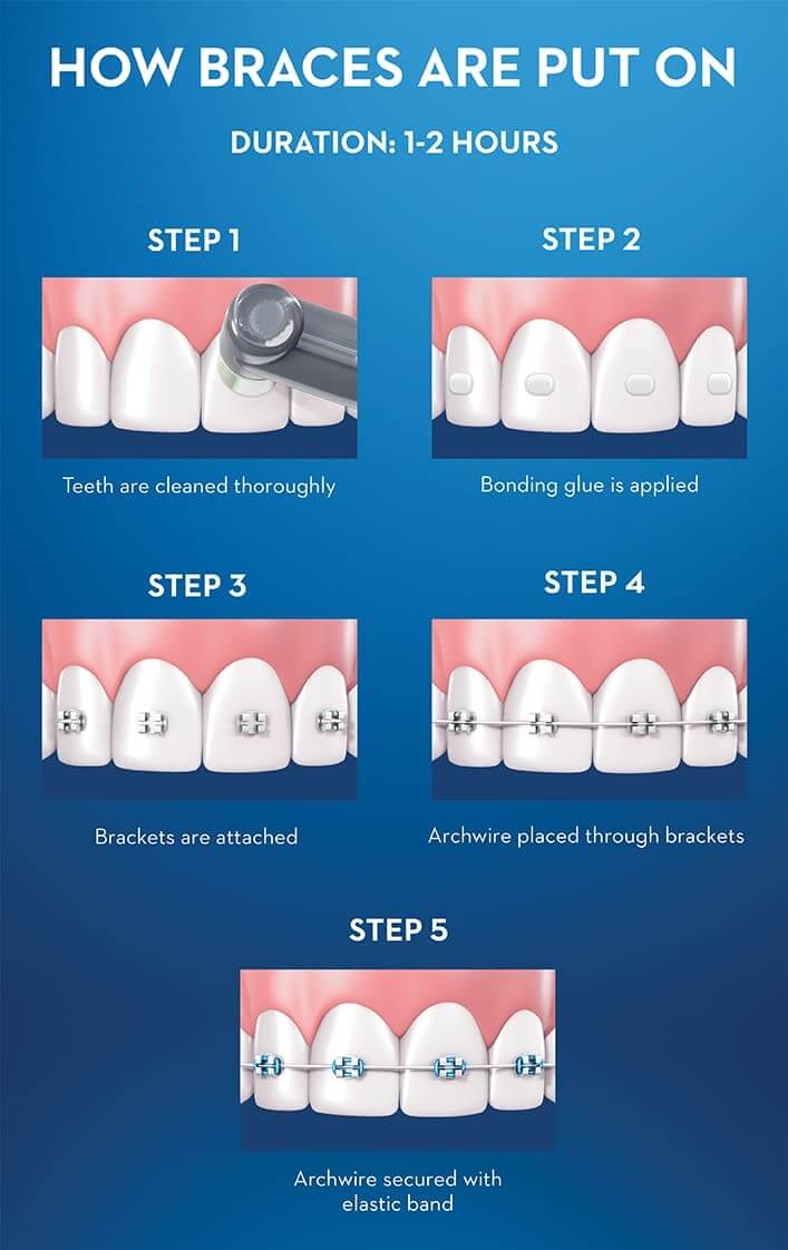 How Braces are Put On