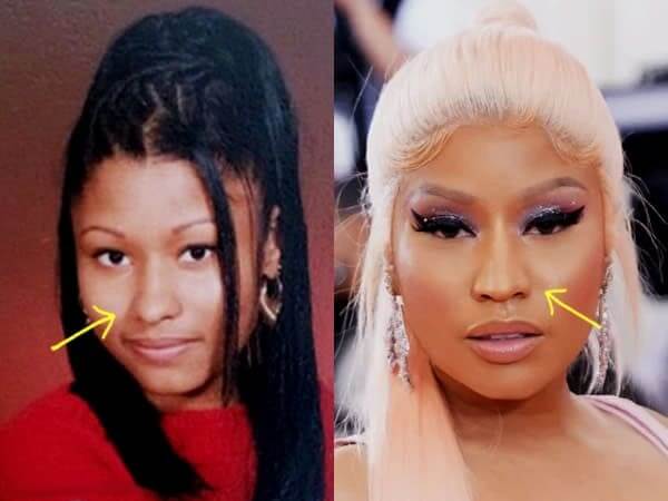 Nicki Minaj Nose Job Before and After