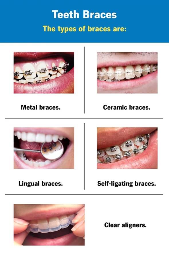 Types of Braces
