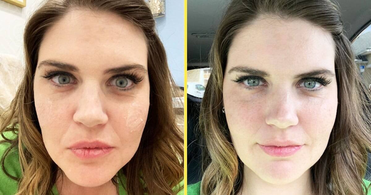 Under Eye Filler Then and Now