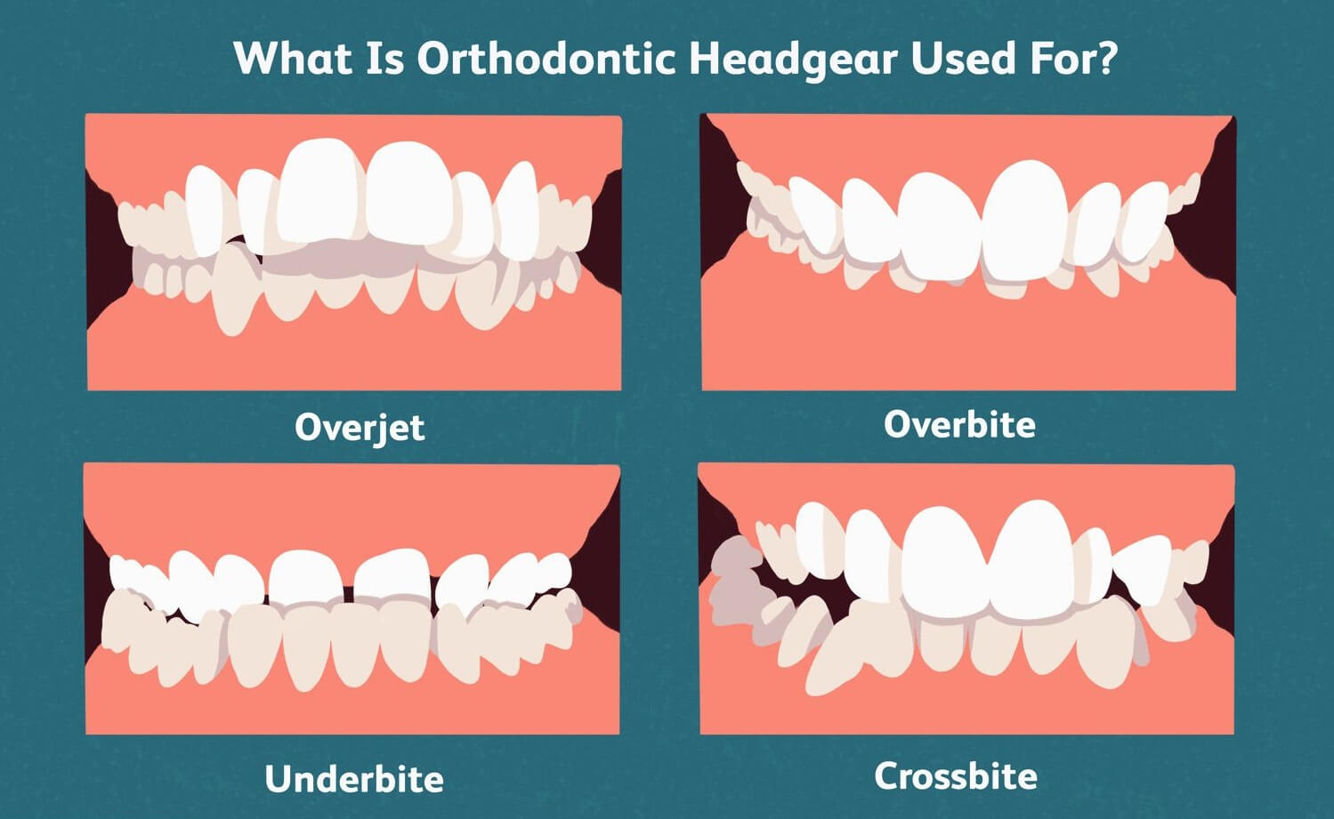 What Is Orthodontic Headgear Used For?