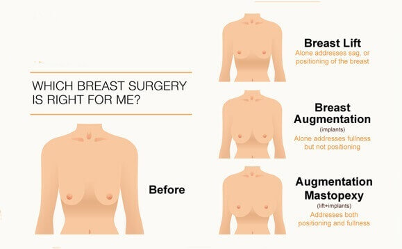 Which Breast Surgery Is Right For Me?