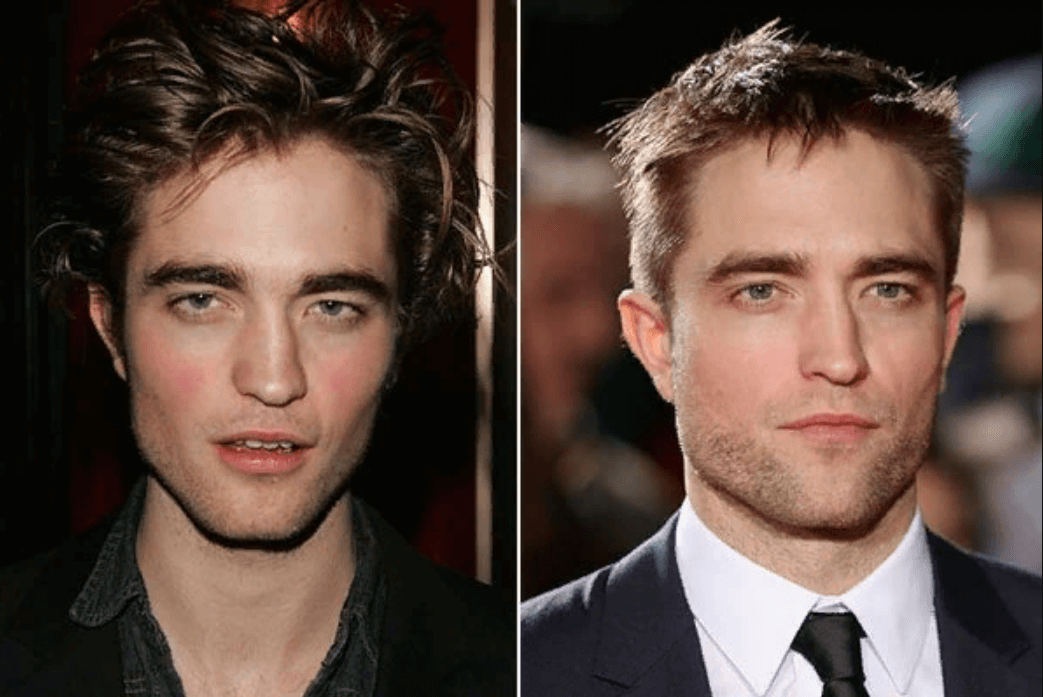 Robert Pattinson Plastic Surgery
